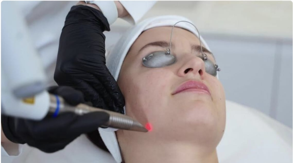 Laser tulowy - game changer w gabinecie kosmetycznym?