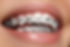 Sonrisa con Ortodoncia convencional .jpg