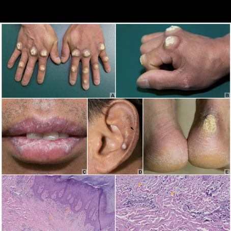 Lúpus Eritematoso Hipertrófico