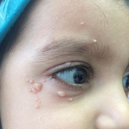 Molusco Contagioso