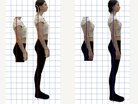 Sway back posture before and after Pilates session showing improved posture alignment, pelvis position, and head-neck alignment at Winsome Pilates in Burnaby.