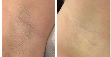 Laser Hair Removal St. Kilda