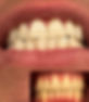 Before After Teeth Whitening