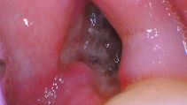 Weird White Stuff in Wisdom Tooth Hole