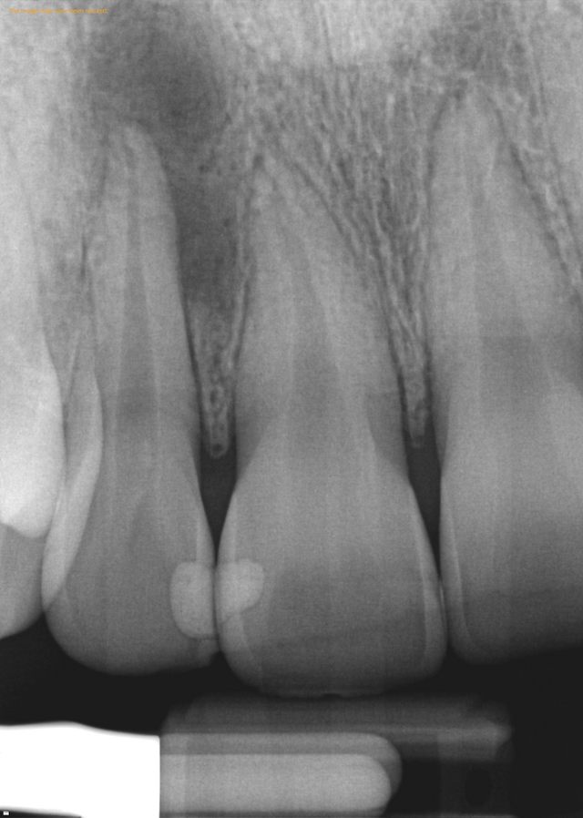 dead tooth root canal before