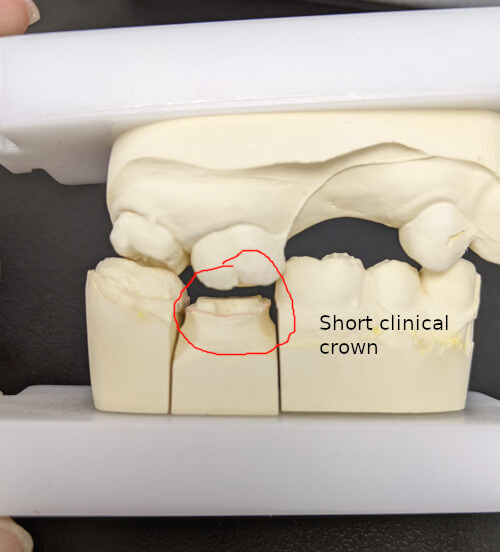 My Dental Implant Crown Keeps Coming Loose 1311 Jackson Ave Dental