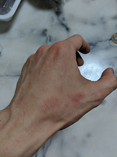 bruise on left hand