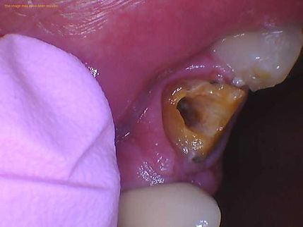 broken tooth with root still in gum