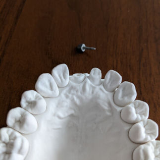 damaged tooth structure without cast post core