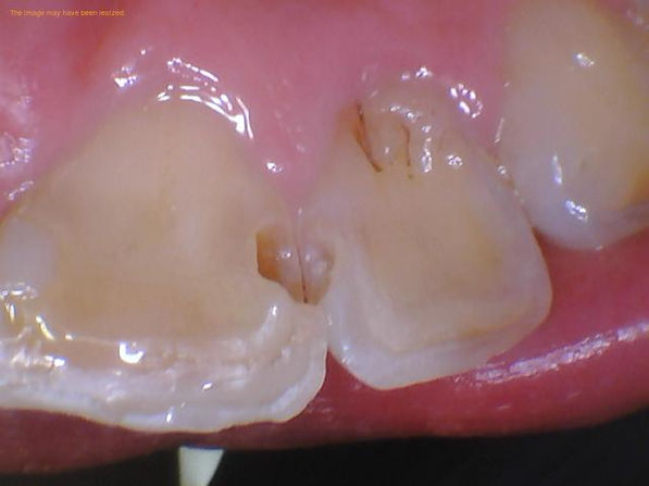 front tooth cavity before filling.jpg