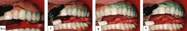 Step 2: applying gum barrier gel