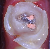 molar after root canal