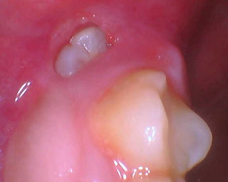 wisdom tooth hole initial presentation