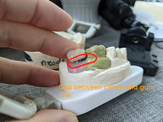 crown with gap