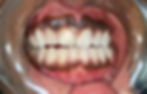 ridges on lower front teeth