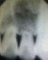 x-ray of shortened front tooth roots due to trauma