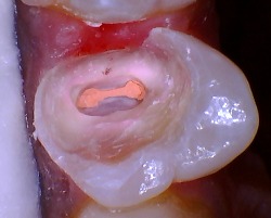 premolar after root canal