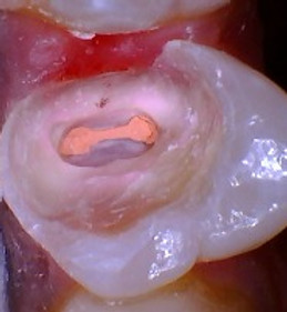 tooth after a root canal