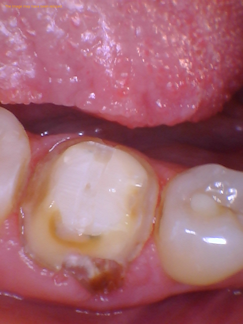 Is It Possible To Get Tooth Decay Under A Crown With Root Canal?