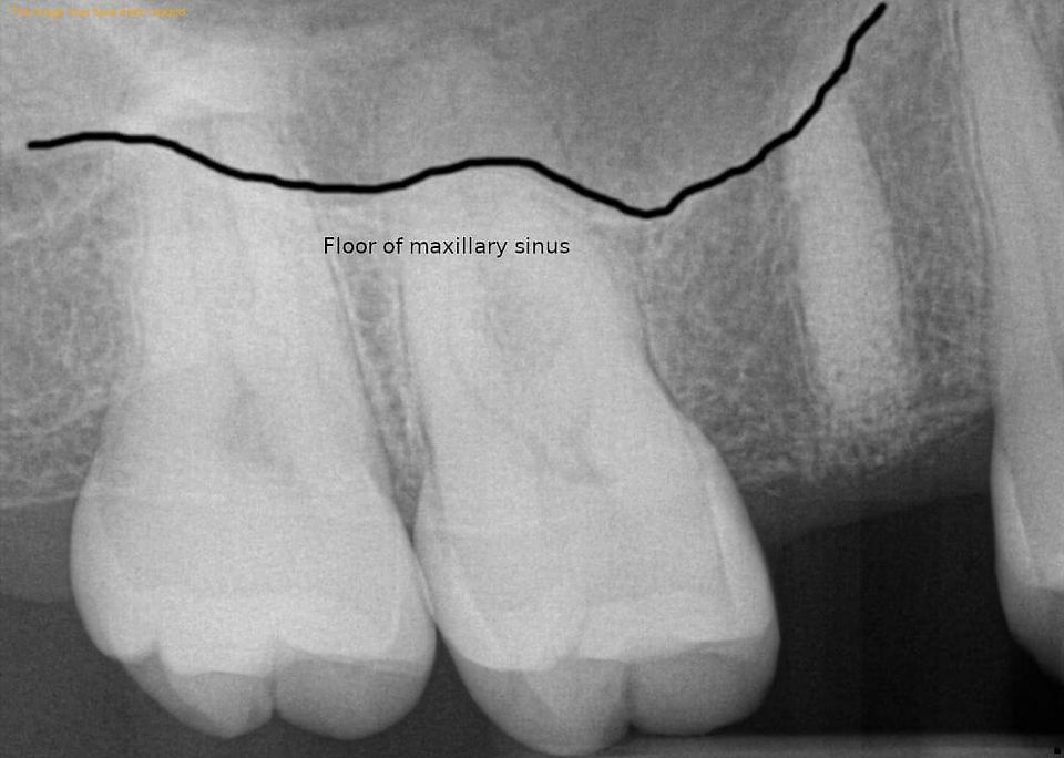 x-ray with marked max sinus