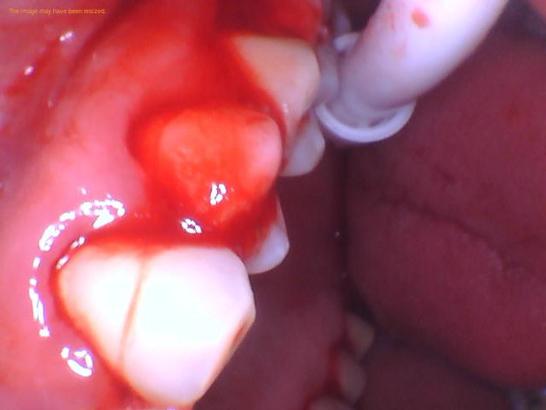 What can I eat after deep cleaning of teeth? - 1311 Jackson Ave Dental