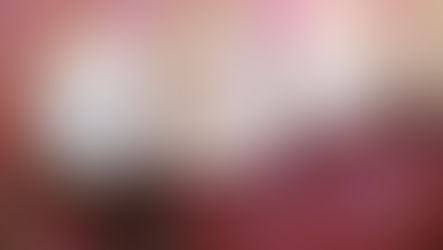 What Dead Teeth Look Like On X-rays