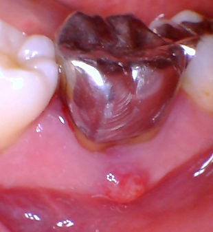 Gum with abscess