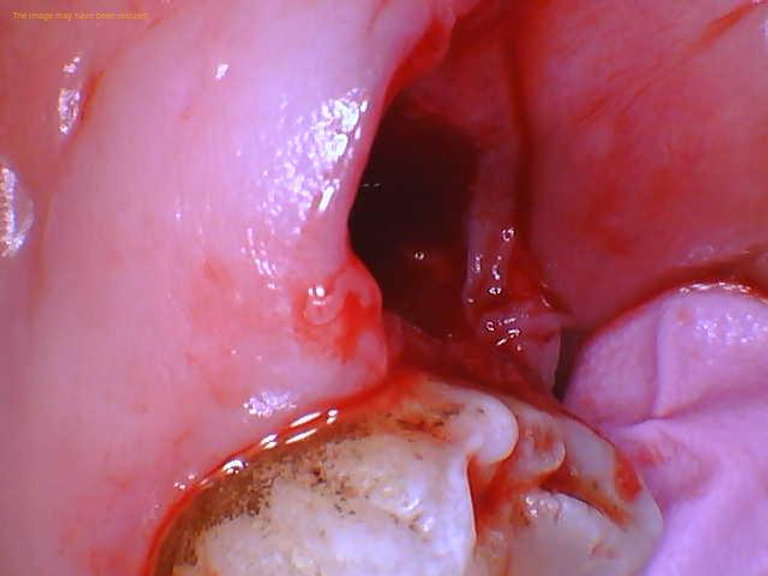 Can Swallowing The Wrong Way Cause a Dry Socket? - 1311 Jackson 