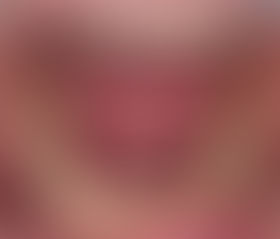 Pictures of Real Wisdom Teeth