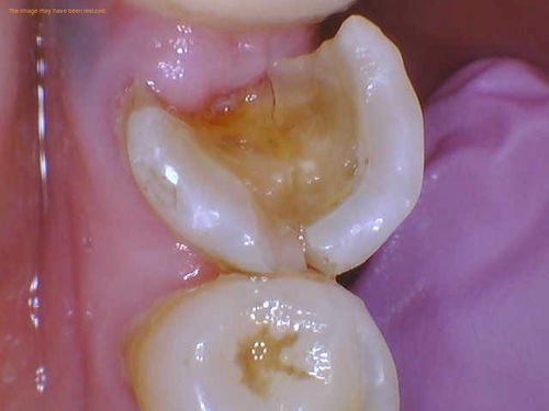 Premolar cracked in half.jpg