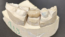 Dental Crown: Things To Know