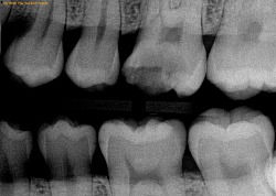 How to Differentiate a Cavity From a Stain