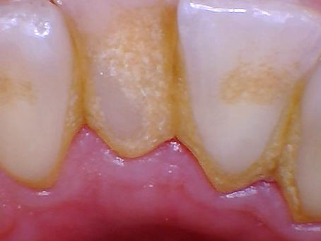 How To Remove Tartar Without a Dentist: The Truth