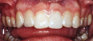 kor seal custom whitening trays