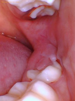 soft tissue impacted wisdom tooth