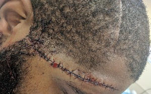 stitches across forehead