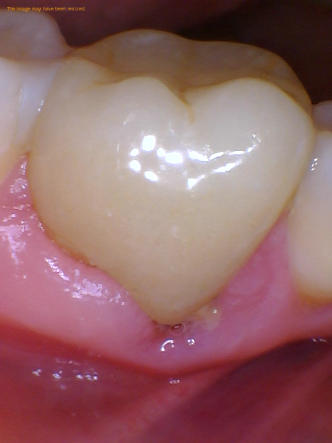 Is It Possible To Get Tooth Decay Under A Crown With Root Canal?