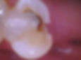 Decay on premolar with chip