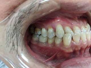 Underbite before right