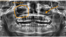 Front Tooth Pain Under Nose