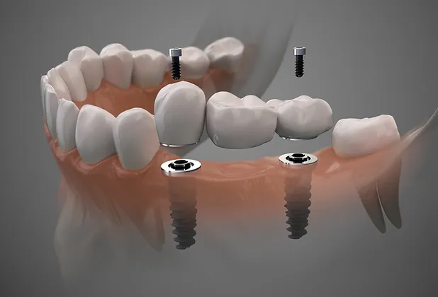 dental implants - 4g dental lab.webp