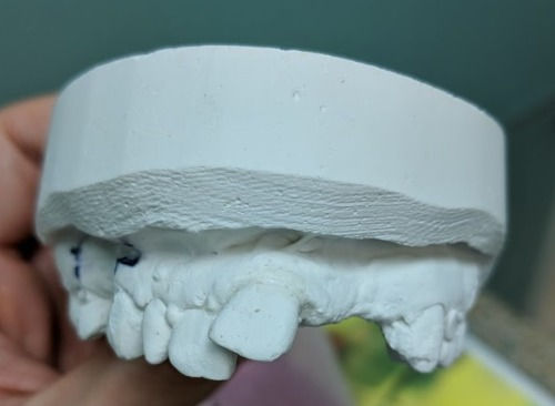 missing and flared teeth