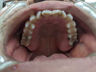 Underbite before upper