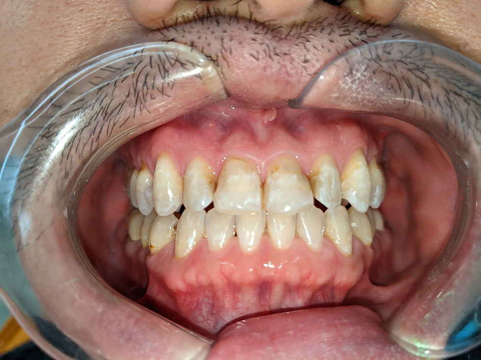 Underbite after front