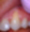 recession on canine tooth