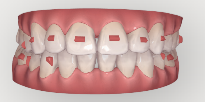 Invisalign plan with attachments
