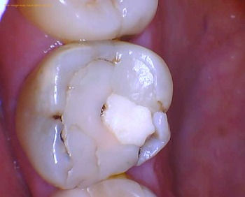 Recurrent decay in existing filling that is breaking down on a molar.jpg