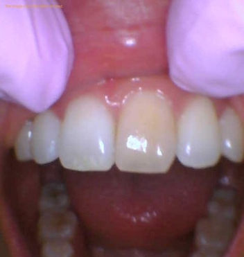 dead front tooth that is discolored