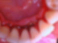 after deep teeth cleaning
