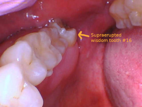 Can I Talk After Wisdom Teeth Removal?